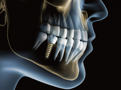 Dentalni implantati