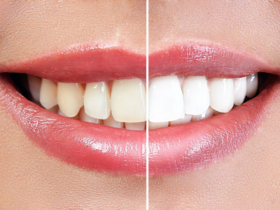 Požuteli zubi - najefikasniji metod izbeljivanja