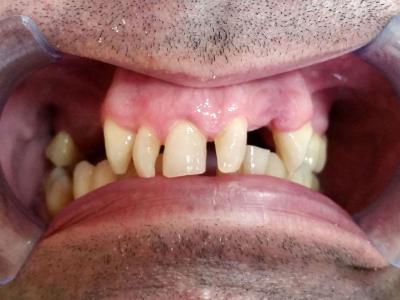 Teeth restoration using metal-ceramic crowns 