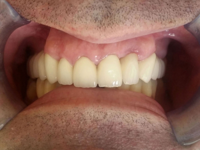 Sanacija zuba metalokeramičkim krunicama