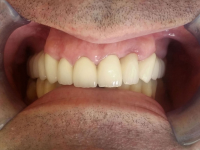 Teeth restoration using metal-ceramic crowns 