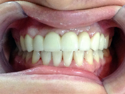 Sanacija zuba hirurškim podizanjem desni i cirkonskim krunicama