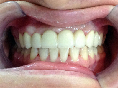 Teeth restoration through surgical gum lift and zirconia-based crowns 