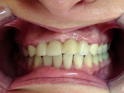 Teeth restoration through surgical gum lift and zirconia-based crowns 