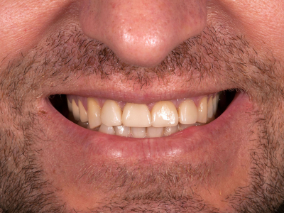 Sanacija frontalnih zuba keramičkim fasetama