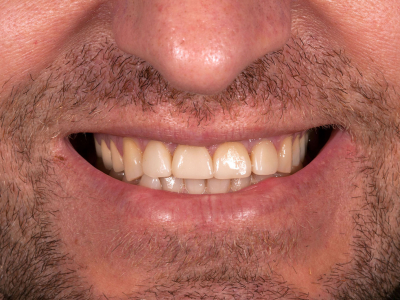 Frontal teeth restoration using ceramic facets