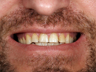 Frontal teeth restoration using ceramic facets