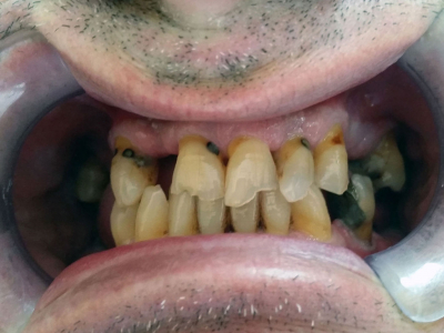 Frontal teeth restoration using metal-ceramic crowns and implants