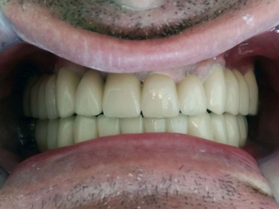 Frontal teeth restoration using metal-ceramic crowns and implants