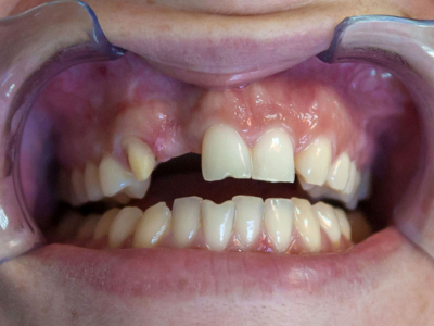 Frontal teeth restoration using ceramic crowns, ceramic veneers and connective tissue transplantation 