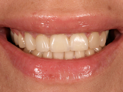 Sanacija prednjih zuba bezmetalnim krunicama, keramičkim fasetama i transplantatom vezivnog tkiva