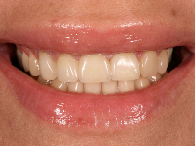 Frontal teeth restoration using ceramic crowns, ceramic veneers and connective tissue transplantation 