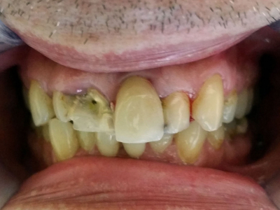 Frontal teeth restoration using ceramic crowns