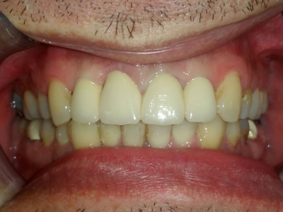 Frontal teeth restoration using ceramic crowns