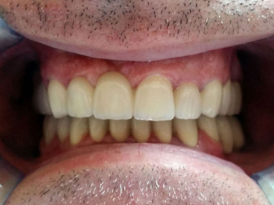 Felső és alsó állkapocs fogászati kezelése cirkon koronákkal, fémkerámia koronákkal és implantátumokkal