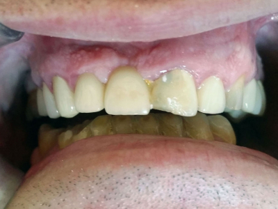 Felső és alsó állkapocs fogászati kezelése cirkon koronákkal, fémkerámia koronákkal és implantátumokkal