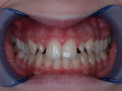 Diastema correction