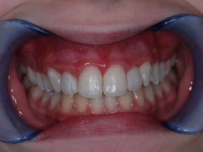 Diastema correction